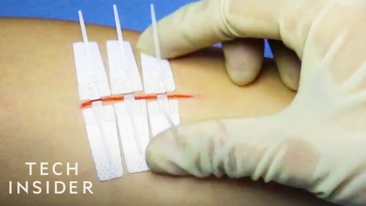 needle-less-alternative-to-stitches-technology-in-business